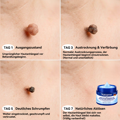 Natravor® 7-Tage-Pflegecreme für Hautanhängsel & Hautflecken (𝐒𝐜𝐡𝐦𝐞𝐫𝐳𝐟𝐫𝐞𝐢𝐞 𝐅𝐨𝐫𝐦𝐞𝐥 – 𝐨𝐡𝐧𝐞 𝐍𝐚𝐫𝐛𝐞𝐧)