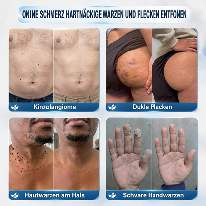 Natravor® 7-Tage-Pflegecreme für Hautanhängsel & Hautflecken (𝐒𝐜𝐡𝐦𝐞𝐫𝐳𝐟𝐫𝐞𝐢𝐞 𝐅𝐨𝐫𝐦𝐞𝐥 – 𝐨𝐡𝐧𝐞 𝐍𝐚𝐫𝐛𝐞𝐧)